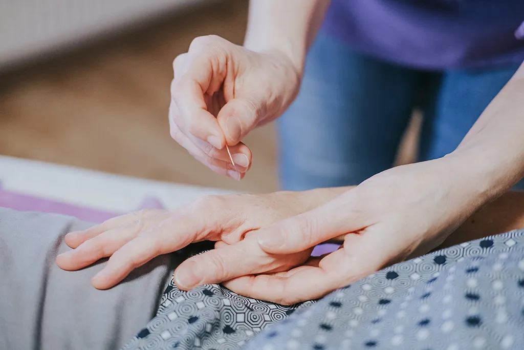 Akupunktur-Anwendung nachgestellt